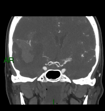Aneurysmal subarachnoid hemorrhage with intra-axial extension (Radiopaedia 84371-99732 C 57).jpg