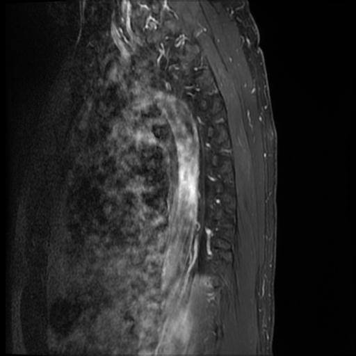 File:Angiolipoma - thoracic spine (Radiopaedia 28242-28479 E 1).jpg