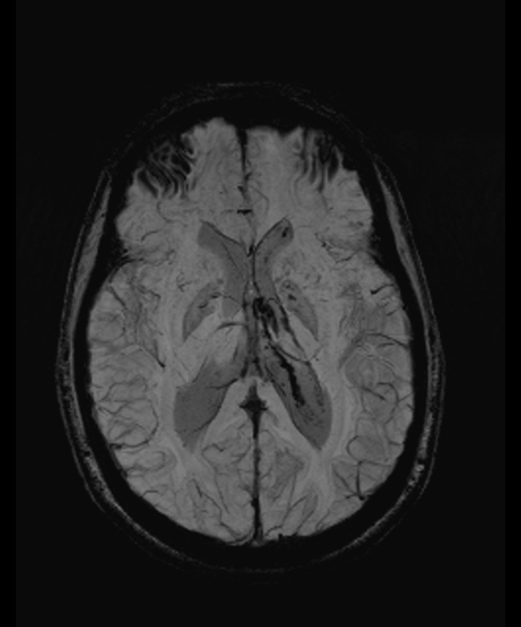 Angiomatous meningioma (Radiopaedia 79459-92579 E 35).jpg