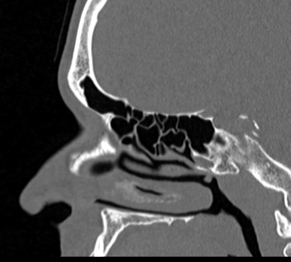 Angular epidermoid cyst (Radiopaedia 46908-51439 Sagittal bone window 53).png