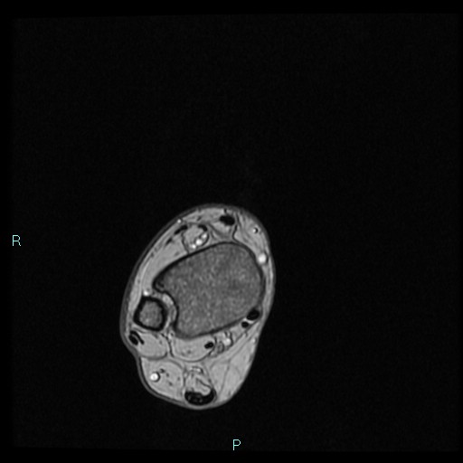 Ankle ganglion cyst (Radiopaedia 62809-71162 Axial Gradient Echo 80).jpg