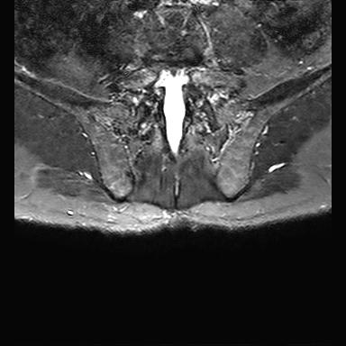 File:Ankylosing spondylitis with zygapophyseal arthritis (Radiopaedia 38433-40517 D 13).jpg
