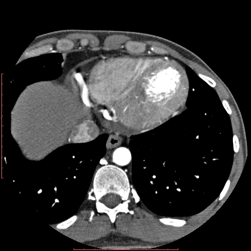 File:Anomalous left coronary artery from the pulmonary artery (ALCAPA) (Radiopaedia 70148-80181 A 324).jpg