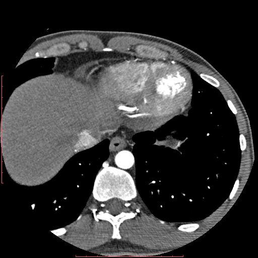 File:Anomalous left coronary artery from the pulmonary artery (ALCAPA) (Radiopaedia 70148-80181 A 346).jpg