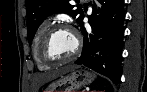 File:Anomalous left coronary artery from the pulmonary artery (ALCAPA) (Radiopaedia 70148-80181 C 180).jpg