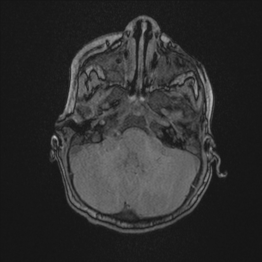Anoxic brain injury (Radiopaedia 79165-92139 Axial MRA 48).jpg