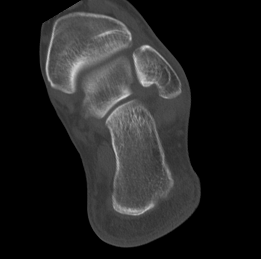Anterior calcaneal process fracture (Radiopaedia 47384-51989 Coronal bone window 65).png