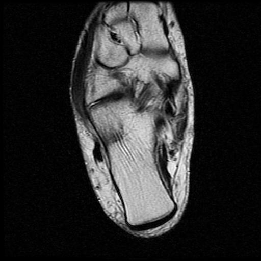 File:Anterior calcaneal process fracture (Radiopaedia 71377-81705 Axial T2 12).jpg