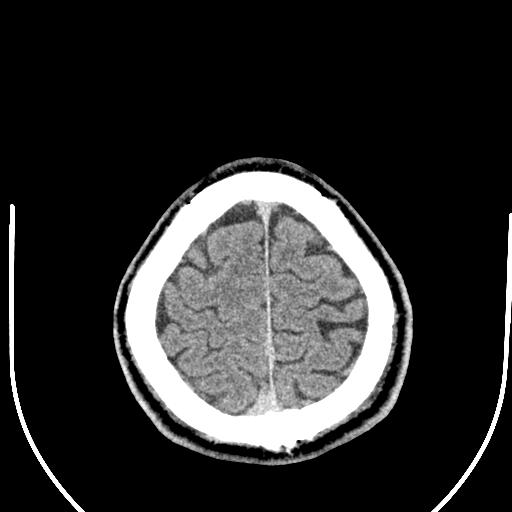 Anterior choroidal artery infarct (Radiopaedia 55106-61480 Axial non-contrast 55).jpg