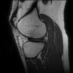 File:Anterior cruciate ligament rupture and posteromedial corner injury (Radiopaedia 67338-76723 Sagittal PD 124).jpg