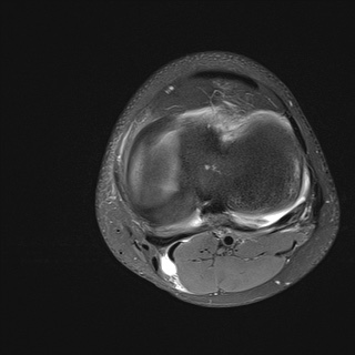 File:Anterior cruciate ligament tear - pediatric (Radiopaedia 62152-70260 Axial PD fat sat 26).jpg