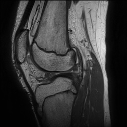 Anterior cruciate ligament tear - pediatric (Radiopaedia 62152-70260 Sagittal PD 103).jpg