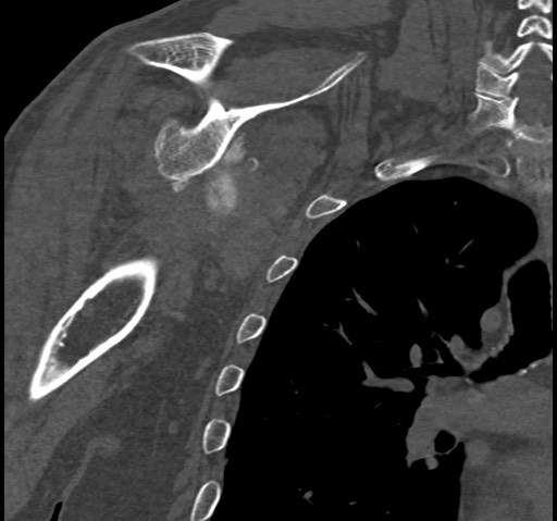 File:Anterior glenohumeral dislocation with Hill-Sachs lesion (Radiopaedia 62877-71249 Coronal bone window 63).jpg