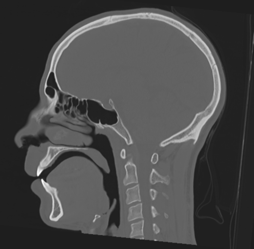 Anterior nasal spine fracture (Radiopaedia 46138-50494 Sagittal bone window 31).png