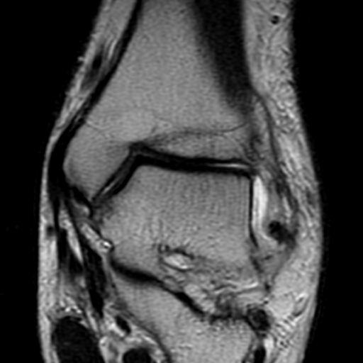 File:Anterior talofibular ligament rupture (Radiopaedia 15831-15484 Coronal T2 9).jpg