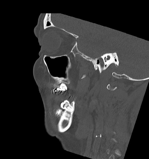 File:Anterior temporomandibular joint dislocation (Radiopaedia 59430-66784 B 17).jpg