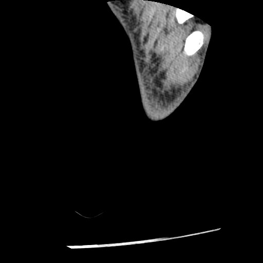 Anterior tibial artery false aneurysm (Radiopaedia 88984-105809 A 267).jpg