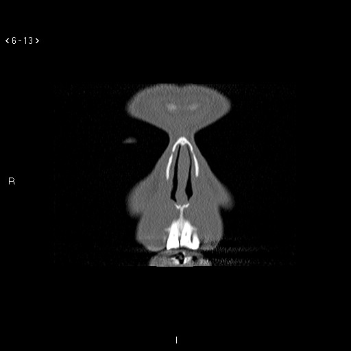 File:Antrochoanal Polyp (Radiopaedia 70510-80631 Coronal bone window 2).jpg