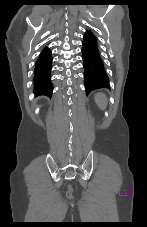 Aortectomy and axillary-bifemoral bypass (Radiopaedia 28303-28545 C 78).jpg
