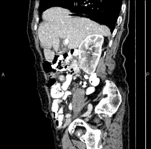 File:Aortic aneurysm and Lemmel syndrome (Radiopaedia 86499-102554 D 26).jpg