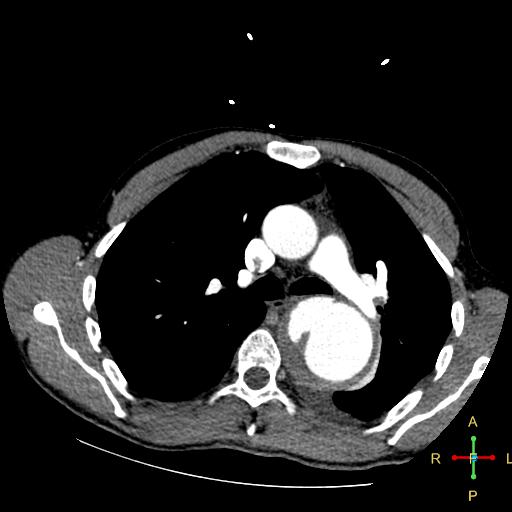File:Aortic aneurysm and penetrating ulcer (Radiopaedia 23590-23704 A 13).jpg