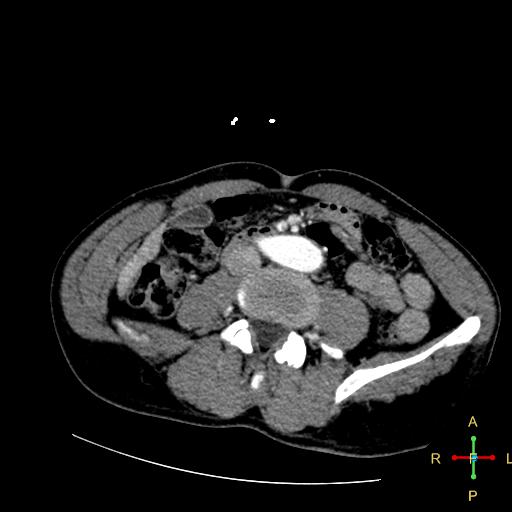 File:Aortic aneurysm and penetrating ulcer (Radiopaedia 23590-23704 A 37).jpg
