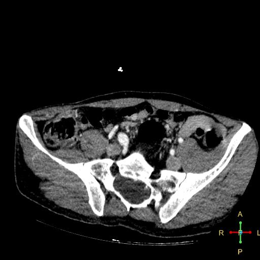 File:Aortic aneurysm and penetrating ulcer (Radiopaedia 23590-23704 A 42).jpg