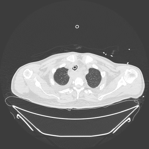 Aortic arch aneurysm (Radiopaedia 84109-99365 Axial lung window 57).jpg
