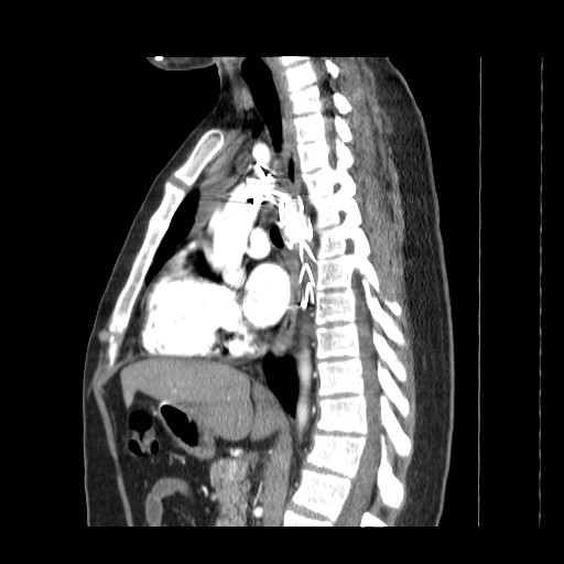 File:Aortic arch stent (Radiopaedia 30030-30595 E 8).jpg
