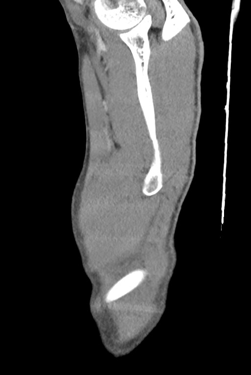 Aortic coarctation with aneurysm (Radiopaedia 74818-85828 B 12).jpg