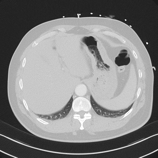 File:Aortic dissection (Radiopaedia 50763-56234 Axial lung window 56).png