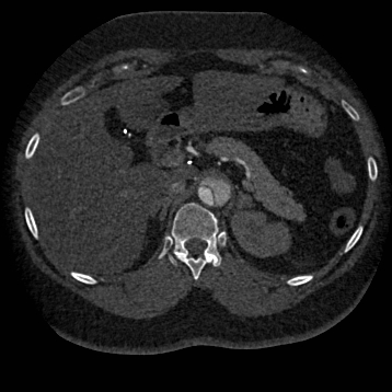 Aortic dissection (Radiopaedia 57969-64959 A 329).jpg