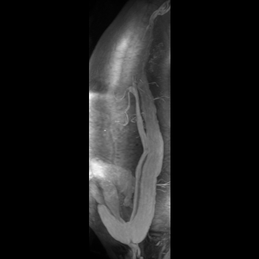 File:Aortic dissection - Stanford A - DeBakey I (Radiopaedia 23469-23551 D 20).jpg