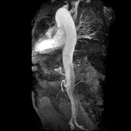 File:Aortic dissection - Stanford A - DeBakey I (Radiopaedia 23469-23551 MRA 16).jpg