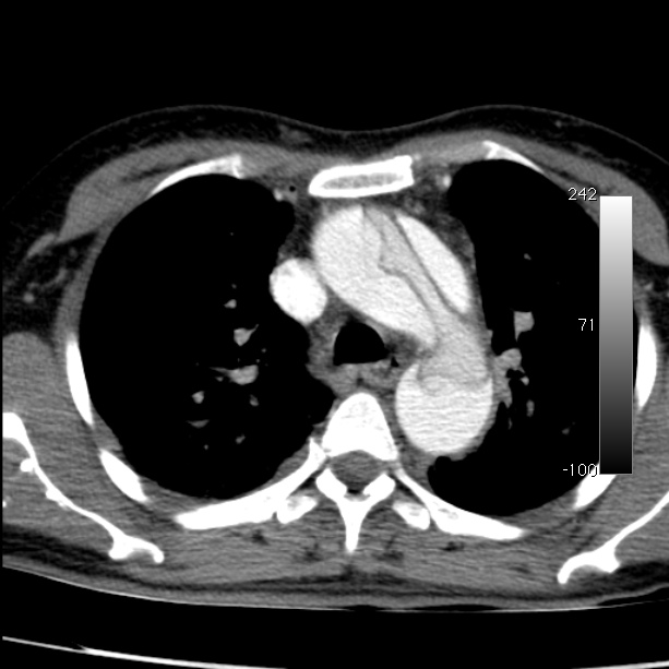 Aortic dissection - Stanford type A (Radiopaedia 29247-29659 A 25).jpg