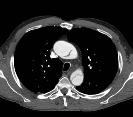 Aortic dissection - Stanford type B (Radiopaedia 73648-84437 A 29).jpg