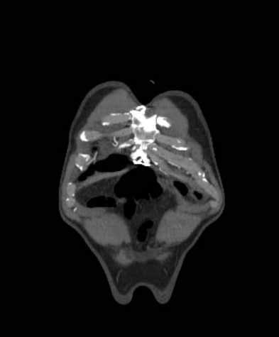 Aortic dissection - Stanford type B (Radiopaedia 73648-84437 B 6).jpg