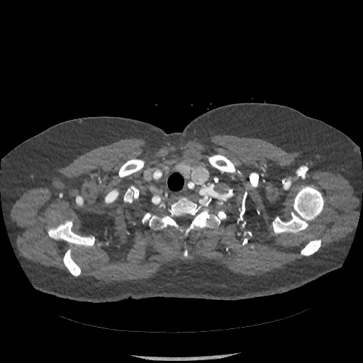 Aortic dissection - Stanford type B (Radiopaedia 88281-104910 A 3).jpg