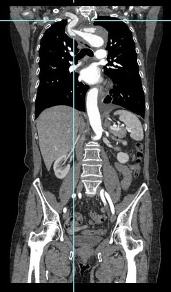 File:Aortic dissection extended to lusory artery (Radiopaedia 43686-47136 C 1).jpeg