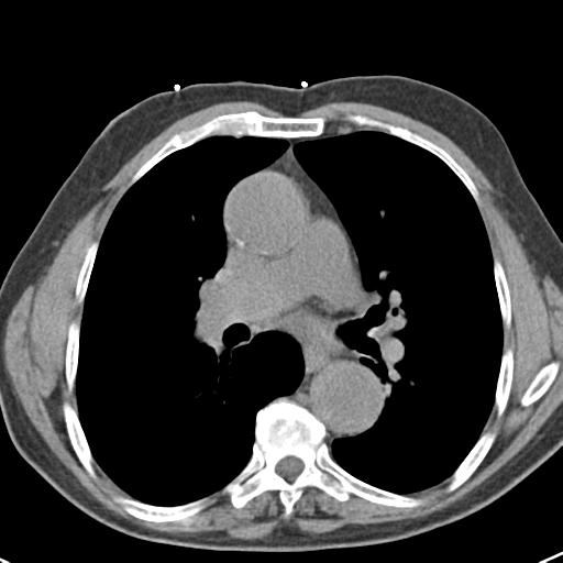 Aortic intramural hematoma (Radiopaedia 31139-31838 Axial non-contrast 27).jpg