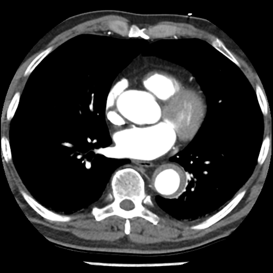 Aortic intramural hematoma (type B) (Radiopaedia 79323-92387 B 32).jpg