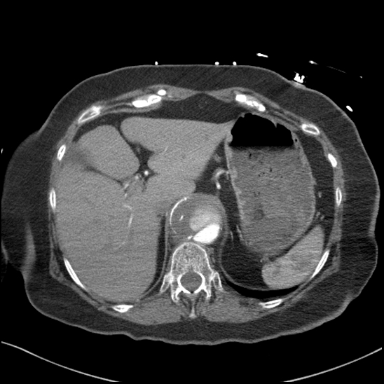 Aortic intramural hematoma with dissection and intramural blood pool (Radiopaedia 77373-89491 B 103).jpg