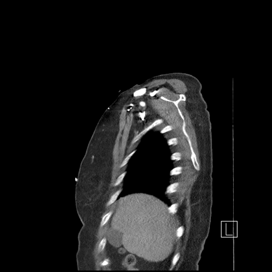 Aortic intramural hematoma with dissection and intramural blood pool (Radiopaedia 77373-89491 D 7).jpg