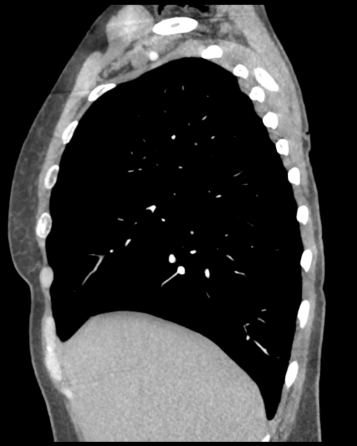 Aortic valve non-coronary cusp thrombus (Radiopaedia 55661-62189 D 40).png