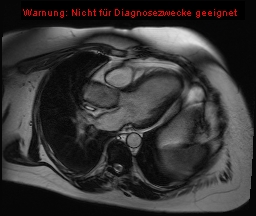File:Aortic valve stenosis in a case of bicuspid aortic valve (Radiopaedia 17785).jpg