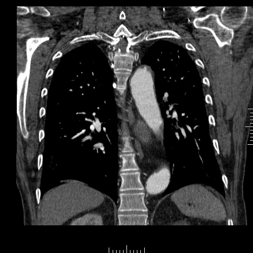 File:Aorto-coronary bypass graft aneurysms (Radiopaedia 40562-43157 B 32).png