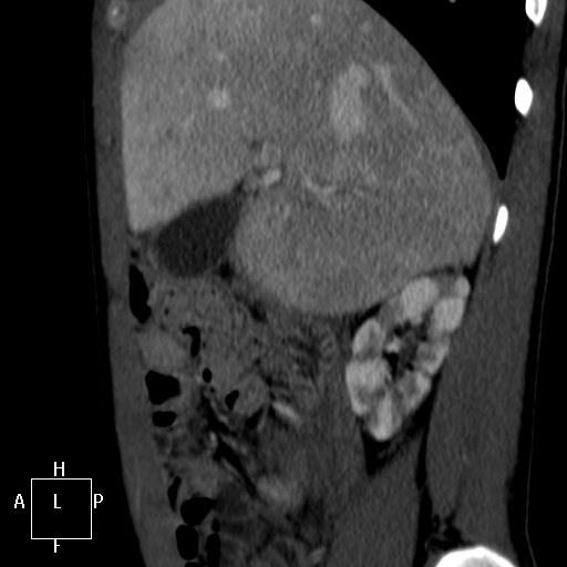 Aorto-left renal vein fistula (Radiopaedia 45534-49628 C 4).jpg