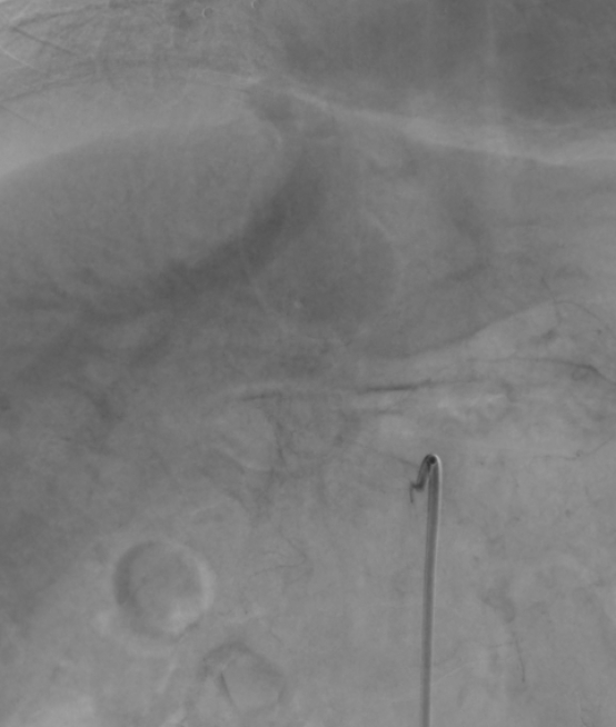 Aorto portal shunt (Radiopaedia 69573-79586 Frontal Celiac axis 78).jpg
