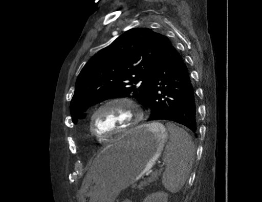 Aortoesophageal fistula with endovascular repair (Radiopaedia 73781-84592 Sagittal C+ CTPA 147).jpg