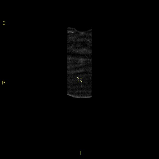 File:Aortoiliac occlusive disease (Radiopaedia 16828-16548 B 3).jpg
